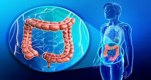 Colon cancer What are the different stages of symptoms?